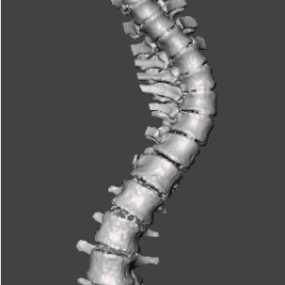 דגם תלת מימד של עצם השדרה של עקמת